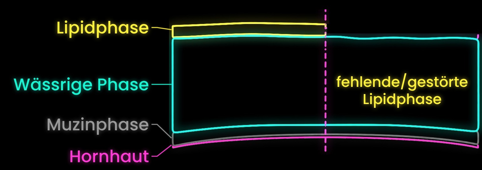 Tränenfilm im Schnitt: Muzinphase, wässrige Phase und Lipidphase; rechts ist die Lipidphase gestört oder fehlt